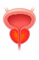 Entzündung vun der Prostata Drüs